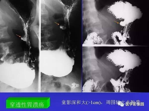 【PPT】胃十二指肠溃疡与胃癌的影像学表现