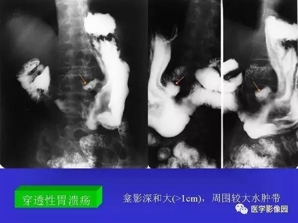 【PPT】胃十二指肠溃疡与胃癌的影像学表现
