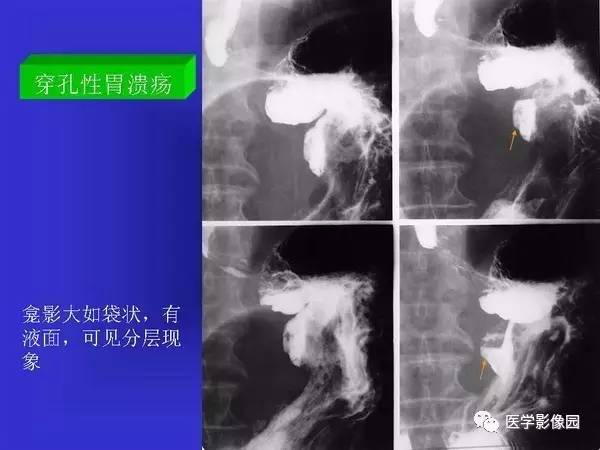【PPT】胃十二指肠溃疡与胃癌的影像学表现