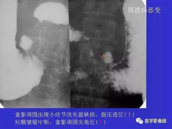 【PPT】胃十二指肠溃疡与胃癌的影像学表现