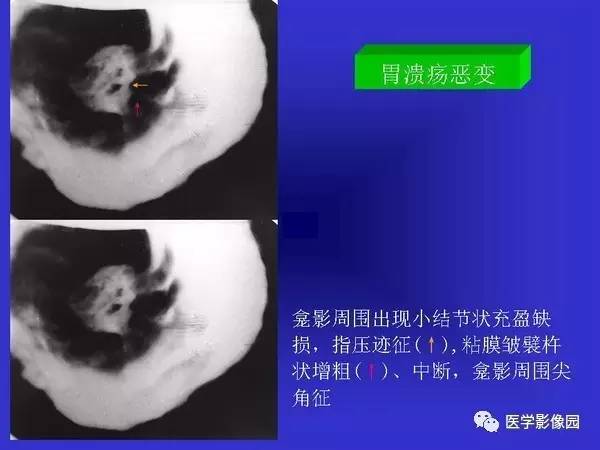 【PPT】胃十二指肠溃疡与胃癌的影像学表现