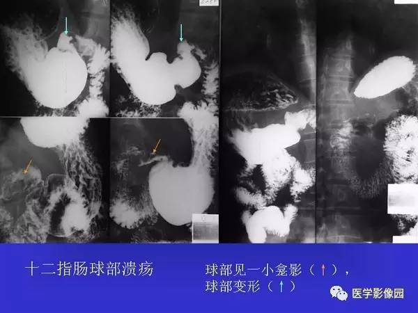 【PPT】胃十二指肠溃疡与胃癌的影像学表现