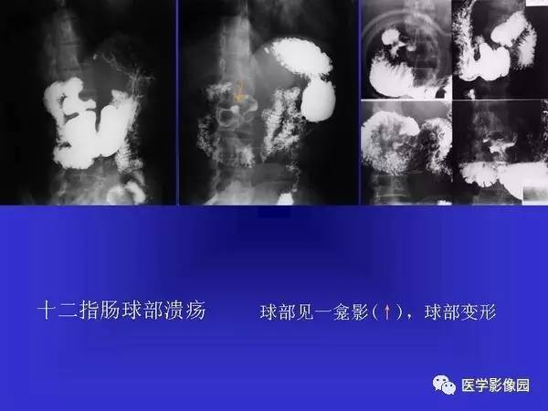 【PPT】胃十二指肠溃疡与胃癌的影像学表现