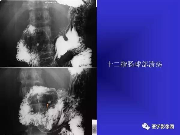 【PPT】胃十二指肠溃疡与胃癌的影像学表现