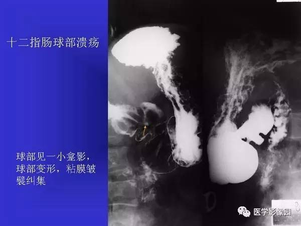 【PPT】胃十二指肠溃疡与胃癌的影像学表现