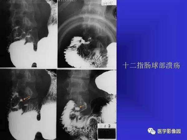 【PPT】胃十二指肠溃疡与胃癌的影像学表现