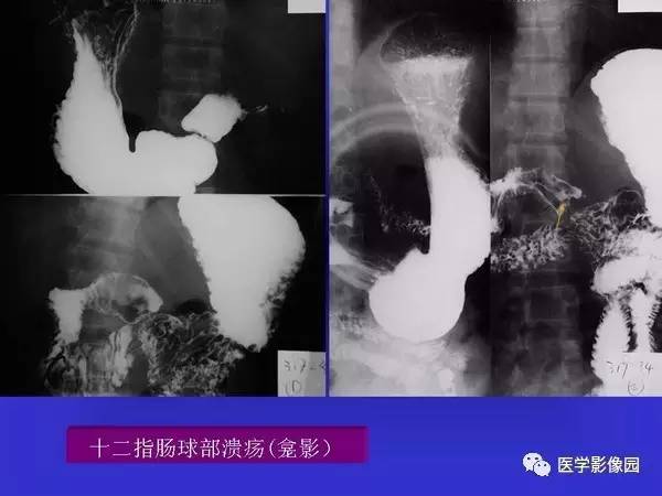 【PPT】胃十二指肠溃疡与胃癌的影像学表现