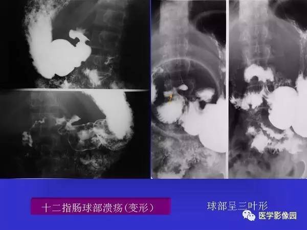 【PPT】胃十二指肠溃疡与胃癌的影像学表现