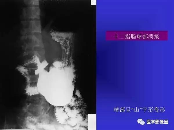【PPT】胃十二指肠溃疡与胃癌的影像学表现