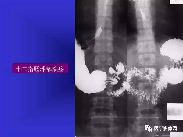 【PPT】胃十二指肠溃疡与胃癌的影像学表现