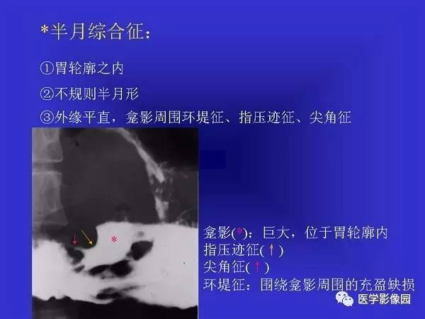 【PPT】胃十二指肠溃疡与胃癌的影像学表现