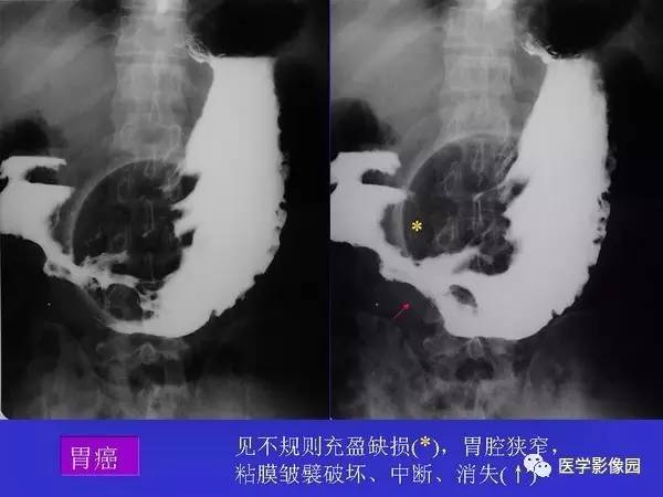 【PPT】胃十二指肠溃疡与胃癌的影像学表现