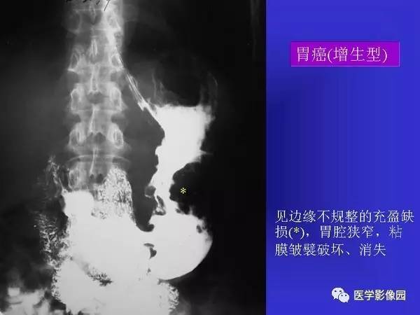 【PPT】胃十二指肠溃疡与胃癌的影像学表现