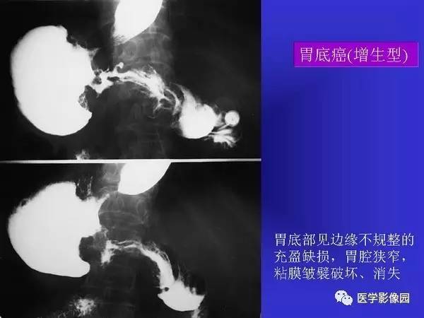 【PPT】胃十二指肠溃疡与胃癌的影像学表现