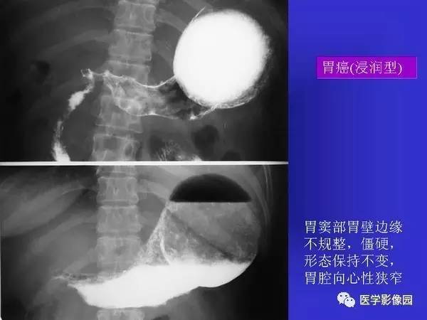 【PPT】胃十二指肠溃疡与胃癌的影像学表现