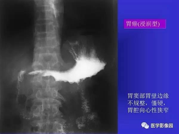 【PPT】胃十二指肠溃疡与胃癌的影像学表现