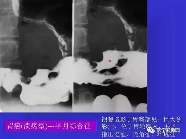 【PPT】胃十二指肠溃疡与胃癌的影像学表现