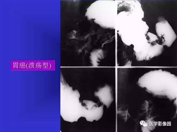 【PPT】胃十二指肠溃疡与胃癌的影像学表现