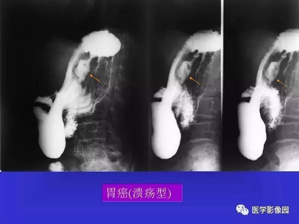 【PPT】胃十二指肠溃疡与胃癌的影像学表现