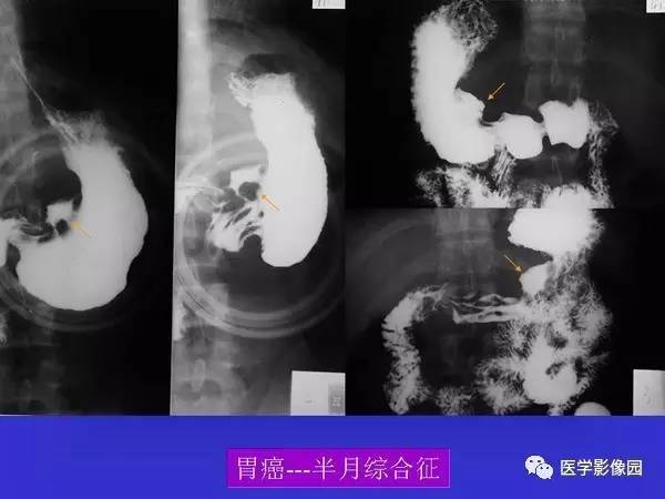 【PPT】胃十二指肠溃疡与胃癌的影像学表现