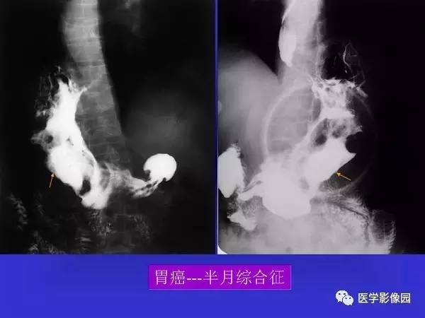 【PPT】胃十二指肠溃疡与胃癌的影像学表现