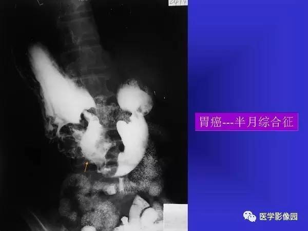【PPT】胃十二指肠溃疡与胃癌的影像学表现