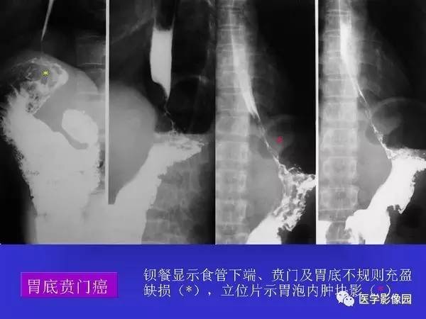 【PPT】胃十二指肠溃疡与胃癌的影像学表现