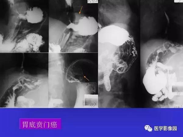 【PPT】胃十二指肠溃疡与胃癌的影像学表现