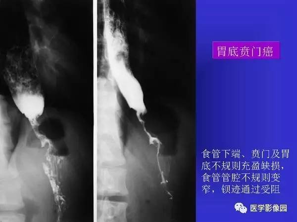 【PPT】胃十二指肠溃疡与胃癌的影像学表现