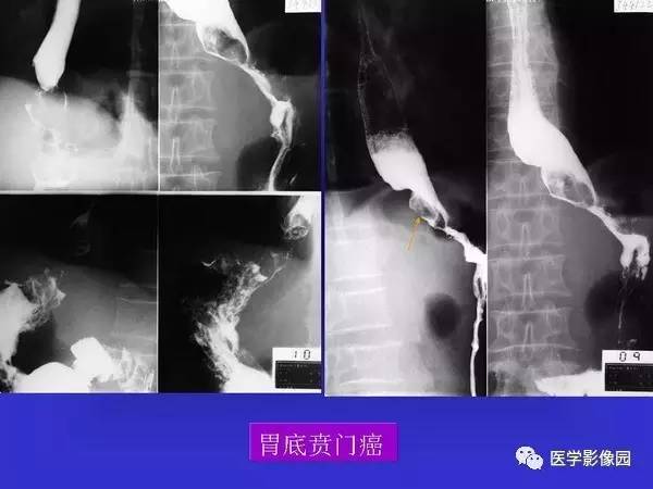 【PPT】胃十二指肠溃疡与胃癌的影像学表现