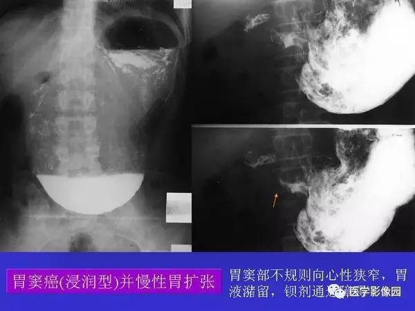 【PPT】胃十二指肠溃疡与胃癌的影像学表现