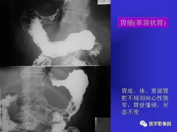【PPT】胃十二指肠溃疡与胃癌的影像学表现
