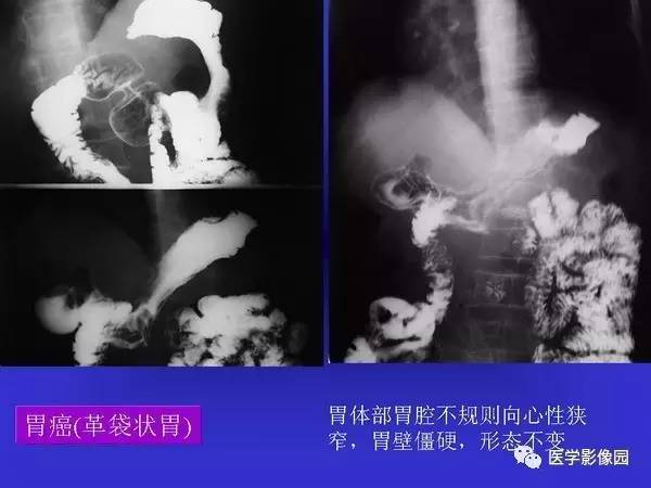 【PPT】胃十二指肠溃疡与胃癌的影像学表现