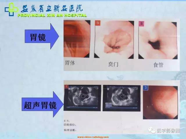 【病例】纵隔型肺癌1例CT影像表现 【病例】纵隔型肺癌1例CT影像表现