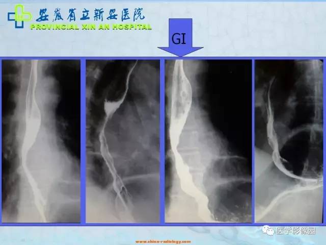 【病例】纵隔型肺癌1例CT影像表现 【病例】纵隔型肺癌1例CT影像表现