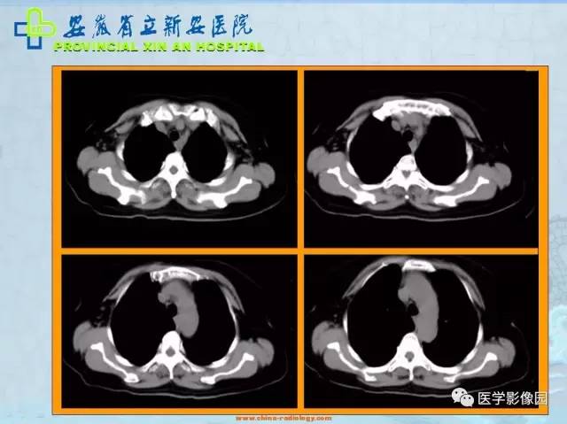 【病例】纵隔型肺癌1例CT影像表现 【病例】纵隔型肺癌1例CT影像表现