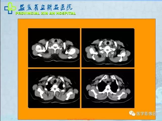 【病例】纵隔型肺癌1例CT影像表现 【病例】纵隔型肺癌1例CT影像表现