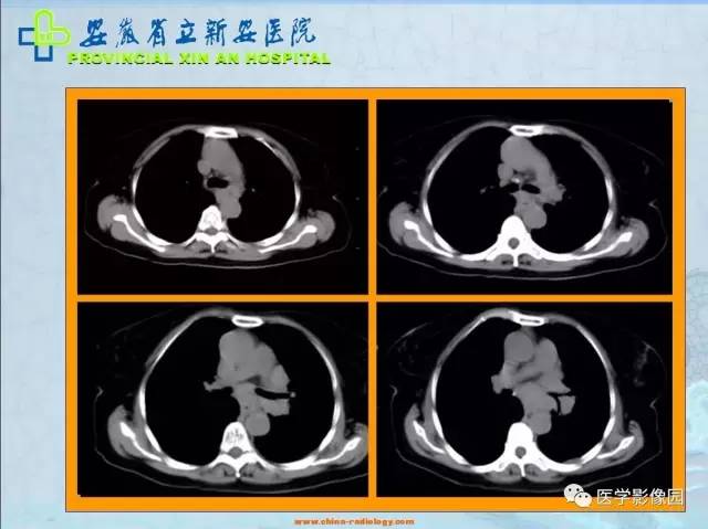 【病例】纵隔型肺癌1例CT影像表现 【病例】纵隔型肺癌1例CT影像表现