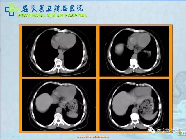 【病例】纵隔型肺癌1例CT影像表现 【病例】纵隔型肺癌1例CT影像表现