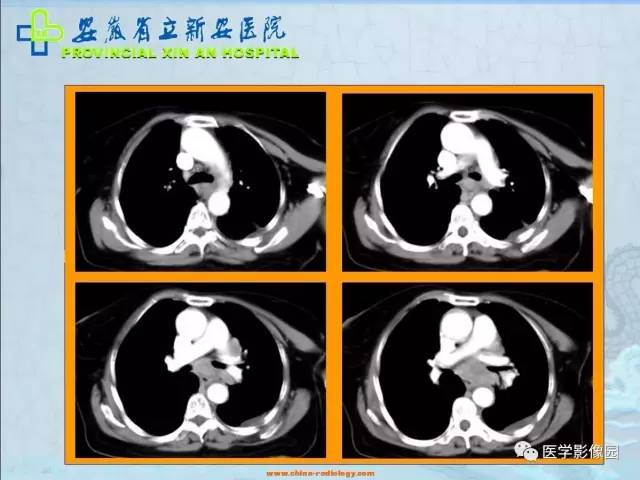 【病例】纵隔型肺癌1例CT影像表现 【病例】纵隔型肺癌1例CT影像表现