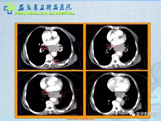 【病例】纵隔型肺癌1例CT影像表现