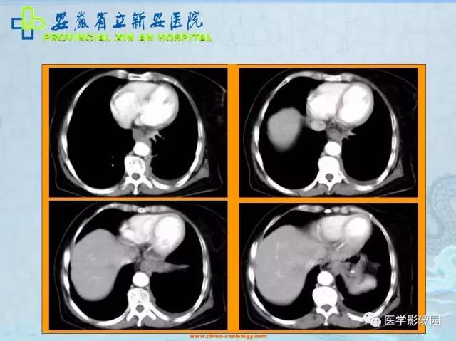 【病例】纵隔型肺癌1例CT影像表现 【病例】纵隔型肺癌1例CT影像表现