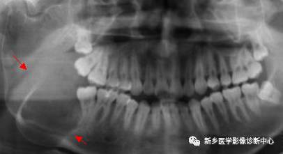 牙齿周围看到的6种囊性病变 牙齿周围看到的6种囊性病变