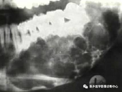 牙齿周围看到的6种囊性病变 牙齿周围看到的6种囊性病变