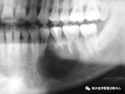 牙齿周围看到的6种囊性病变 牙齿周围看到的6种囊性病变