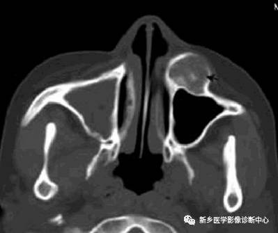 牙齿周围看到的6种囊性病变