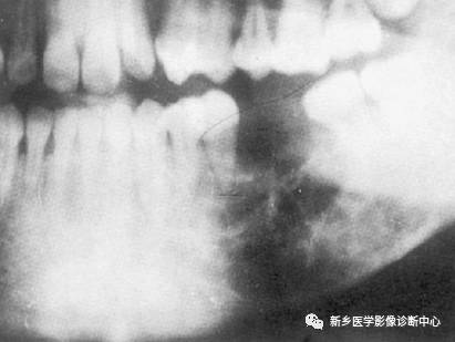 牙齿周围看到的6种囊性病变 牙齿周围看到的6种囊性病变