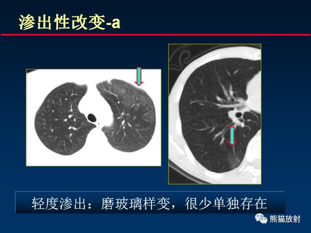 【PPT】肺结核的基础CT表现