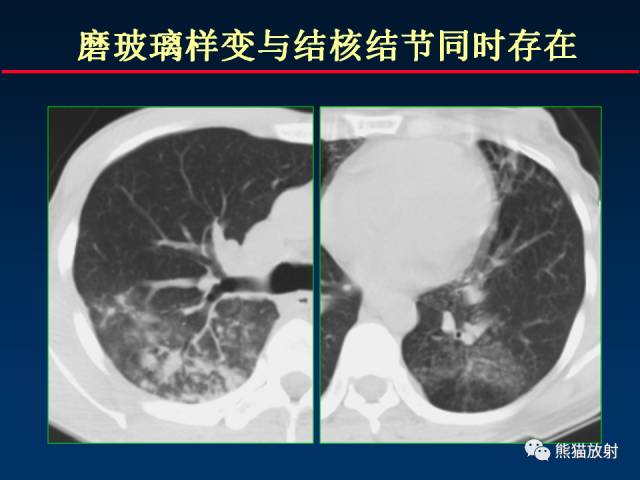 【PPT】肺结核的基础CT表现