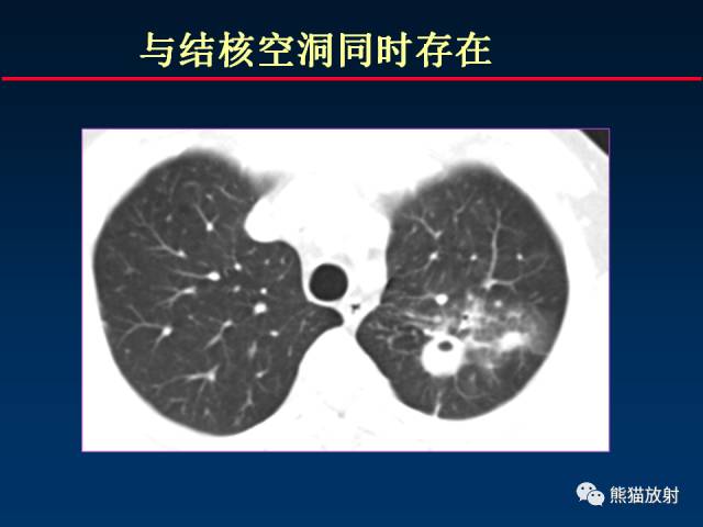 【PPT】肺结核的基础CT表现